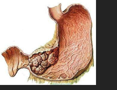 胃癌的病因